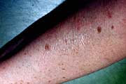 Arm with dried semen in daylight