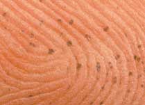Silver stains on the skin, caused by silver nitrate (close-up)